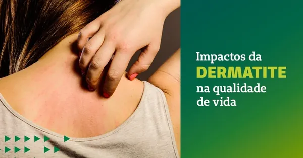 ARTIGO: Impactos da dermatite na qualidade de vida