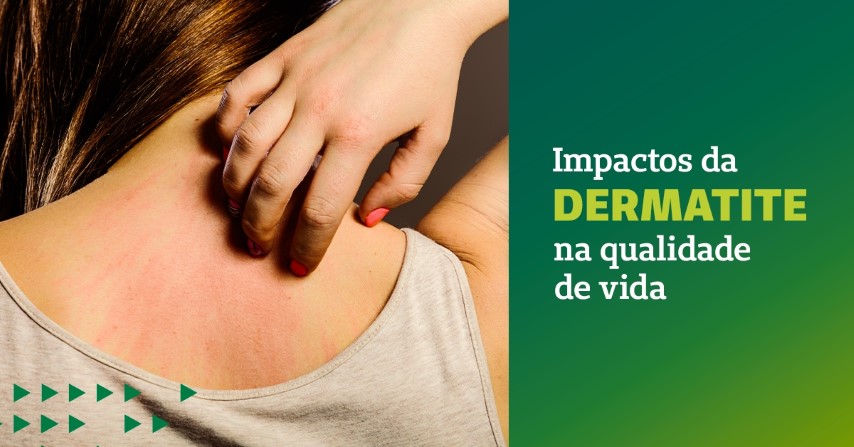 ARTIGO: Impactos da dermatite na qualidade de vida